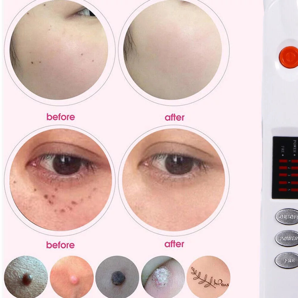 Plasma Laser Pen for Skin Spot and Wart Removal X3287